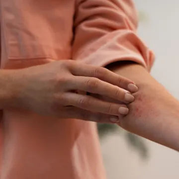 Vrućine utječu na ovu kožnu bolest: Dermatolozi objasnili za&scaron;to se simptomi pogor&scaron;avaju